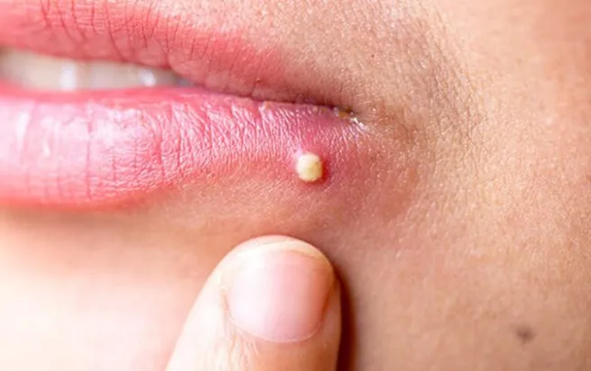 10 cách nhận diện các loại mụn trên khuôn mặt bạn nên biết