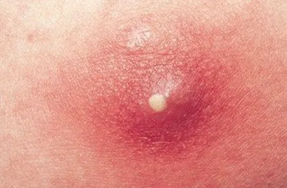 10 cách nhận diện các loại mụn trên khuôn mặt bạn nên biết