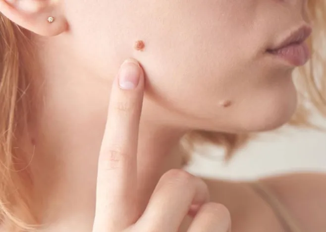 10 cách nhận diện các loại mụn trên khuôn mặt bạn nên biết