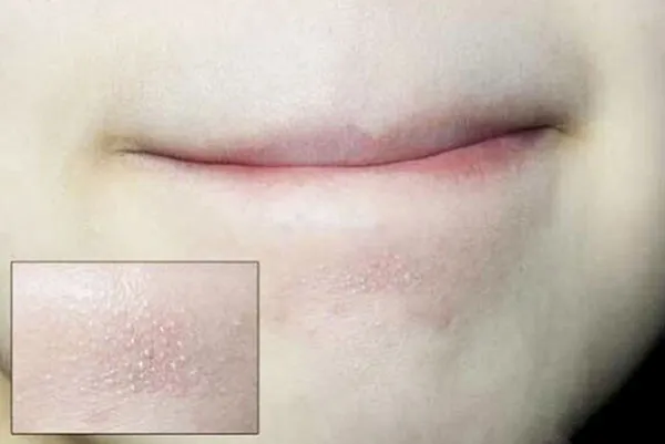 Top 10 cách hỗ trợ làm sạch mụn cám tại nhà từ các nguyên liệu thiên nhiên