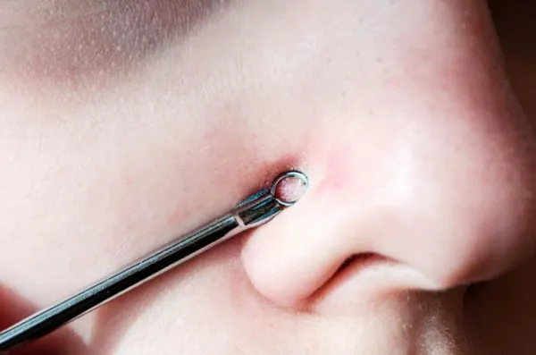Top 10 cách hỗ trợ làm sạch mụn cám tại nhà từ các nguyên liệu thiên nhiên