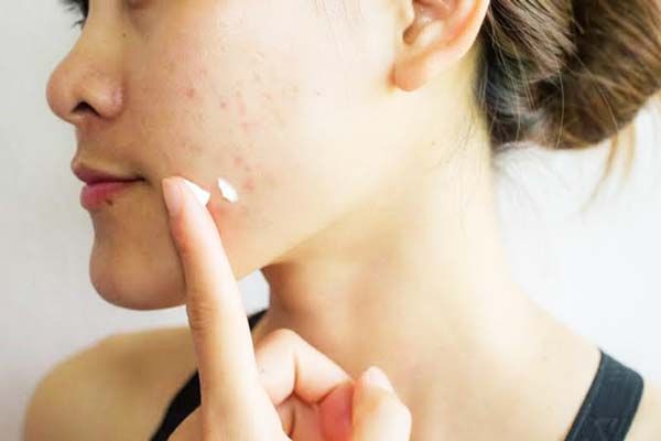 Top 11 cách hỗ trợ làm sạch mụn thâm hiệu quả và nhanh chóng ngay tại nhà