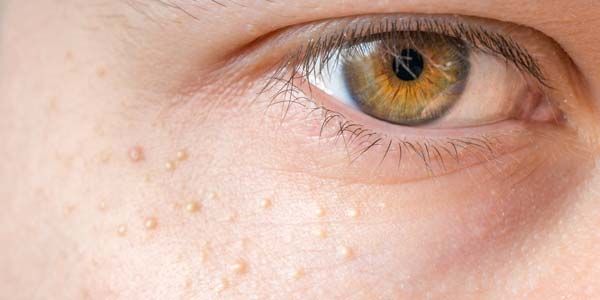 Top 13 cách hỗ trợ làm sạch mụn thịt tận gốc hiệu quả và thân thiện với làn da tại nhà - 1