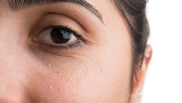 Top 13 cách hỗ trợ làm sạch mụn thịt tận gốc hiệu quả và thân thiện với làn da tại nhà - 3