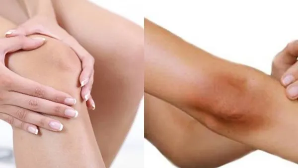 Phương pháp trị thâm đầu gối và khuỷu tay cho nữ tại nhà hiệu quả