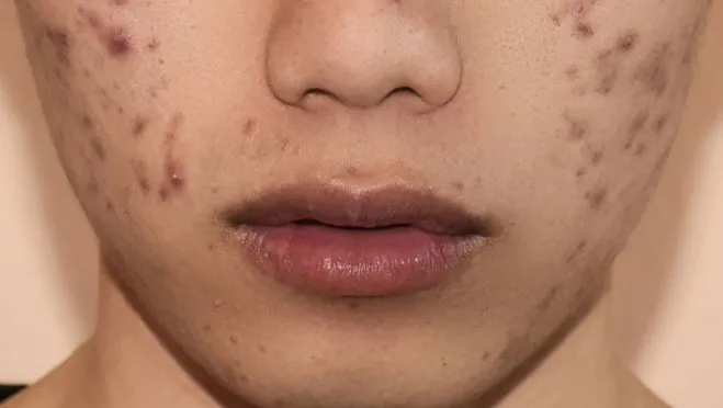 Review 15 kem trị thâm mụn lâu năm hiệu quả tốc độ vượt trội tại nhà