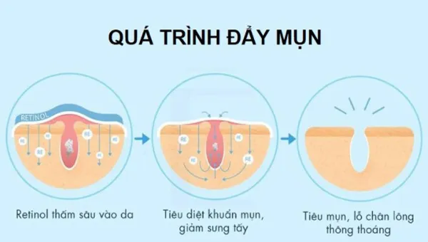 Retinol đẩy mụn trong bao lâu 2