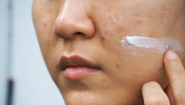 Retinol đẩy mụn trong bao lâu 3