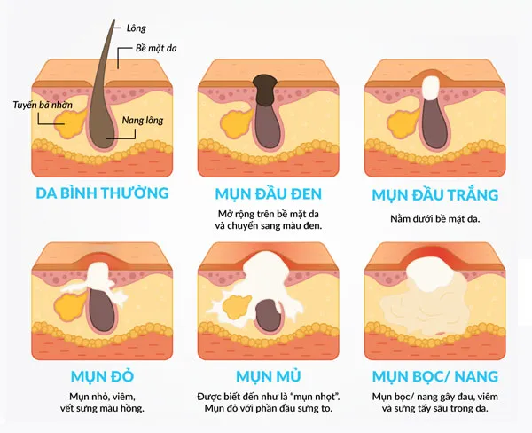 Top 9 kem hỗ trợ làm sạch mụn chất lượng tốt mang hiệu quả cao được tin dùng năm 2025