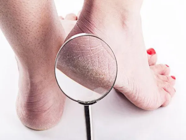 8 cách chăm sóc da gót chân và bàn chân tại nhà hiệu quả 1