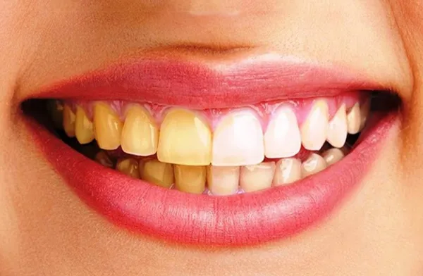 12 cách làm trắng răng bị ố vàng hiệu quả tức thì thân thiện với làn da tại nhà