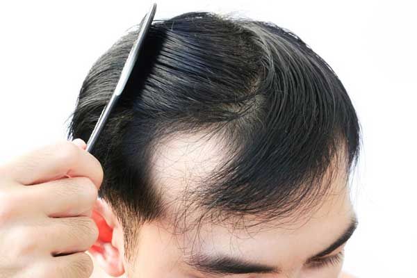 12 cách trị rụng tóc từ thiên nhiên hiệu quả và thân thiện với làn da tại nhà