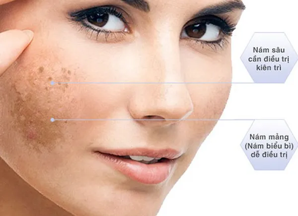 Nám chân sâu là gì? 15 cách trị nám chân sâu tại nhà hiệu quả 1