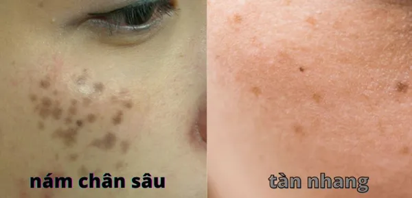 Nám chân sâu là gì? 15 cách trị nám chân sâu tại nhà hiệu quả 2