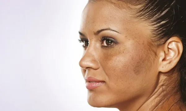 Nám chân sâu là gì? 15 cách trị nám chân sâu tại nhà hiệu quả 5