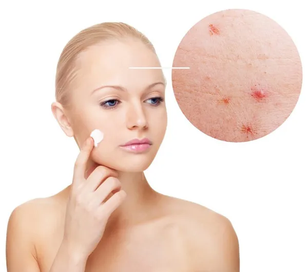 Top 9 serum hỗ trợ làm sạch mụn cho da khô được nhiều chị em đánh giá được nhiều khách hàng yêu thích 3