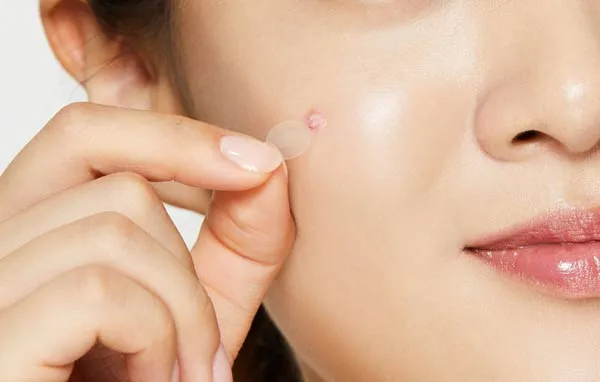 10 cách chăm sóc da sau khi nặn mụn tránh bị thâm sẹo - 8