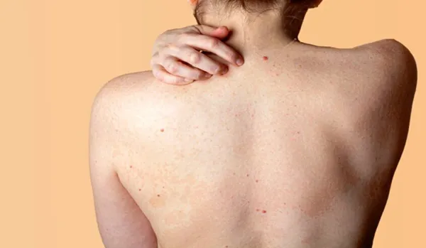 Top 11 cách hỗ trợ làm sạch mụn lưng nam nhanh chóng hiệu quả trong 1 tuần 2