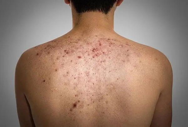 Top 11 cách hỗ trợ làm sạch mụn lưng nam nhanh chóng hiệu quả trong 1 tuần 4