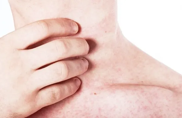 Top 11+ cách trị rôm sảy ở người lớn cải thiện nhanh giúp cải thiện đáng kể điểm tại nhà 1