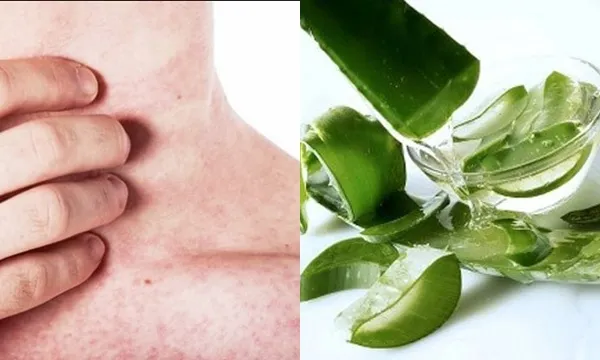 Top 11+ cách trị rôm sảy ở người lớn cải thiện nhanh giúp cải thiện đáng kể điểm tại nhà 10