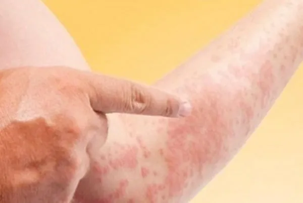 Top 11+ cách trị rôm sảy ở người lớn cải thiện nhanh giúp cải thiện đáng kể điểm tại nhà 14