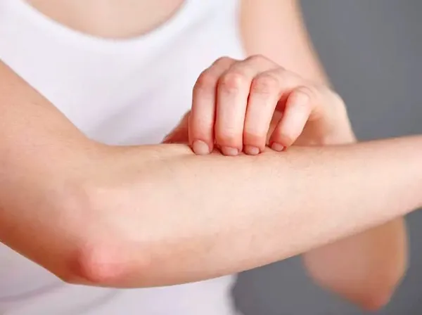 Top 11+ cách trị rôm sảy ở người lớn cải thiện nhanh giúp cải thiện đáng kể điểm tại nhà 2