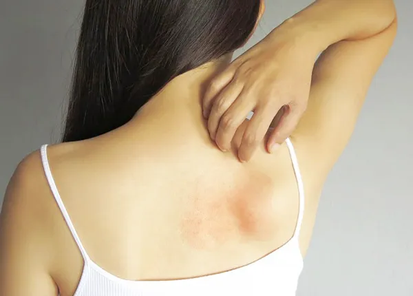 Top 11+ cách trị rôm sảy ở người lớn cải thiện nhanh giúp cải thiện đáng kể điểm tại nhà 4