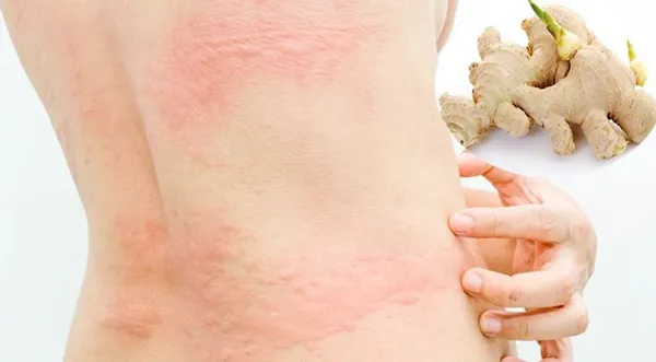 Top 11+ cách trị rôm sảy ở người lớn cải thiện nhanh giúp cải thiện đáng kể điểm tại nhà 7