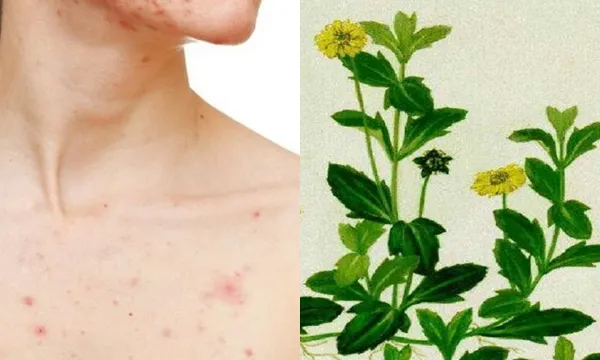 Top 11+ cách trị rôm sảy ở người lớn cải thiện nhanh giúp cải thiện đáng kể điểm tại nhà 8