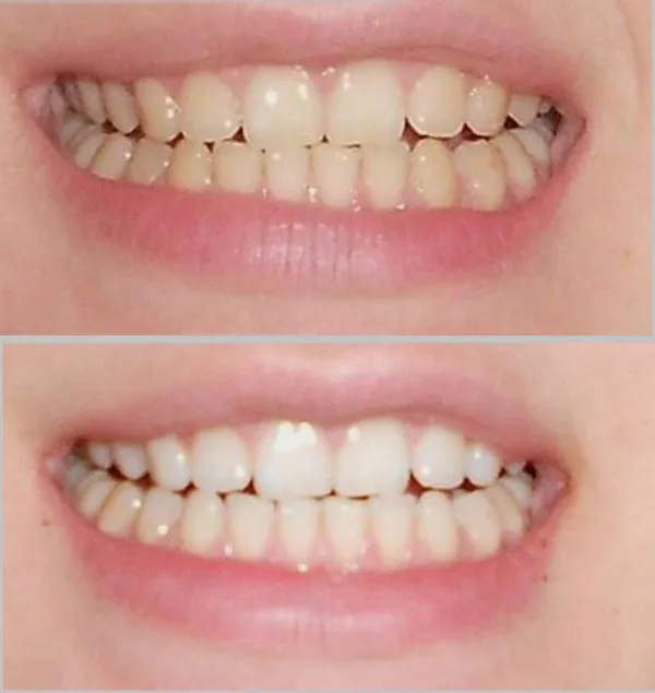 Miếng dán trắng răng có tốt không? Top 5 miếng dán trắng răng bán chạy
