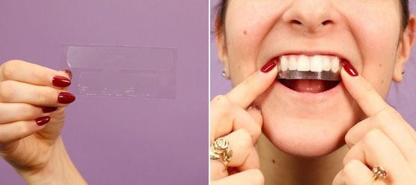 Miếng dán trắng răng có tốt không? Top 5 miếng dán trắng răng bán chạy