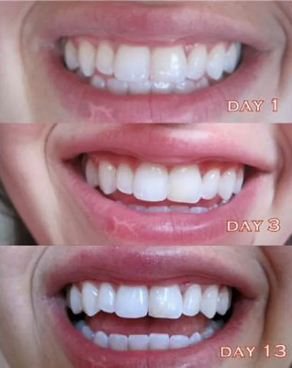 Miếng dán trắng răng có tốt không? Top 5 miếng dán trắng răng bán chạy