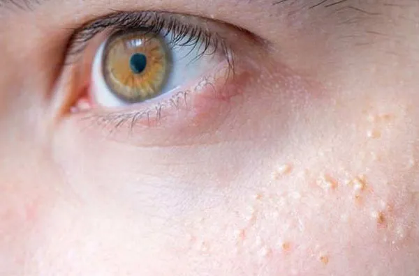 Hướng dẫn 6 cách hỗ trợ làm sạch mụn thịt quanh mắt giúp cải thiện đáng kể điểm tại nhà 1