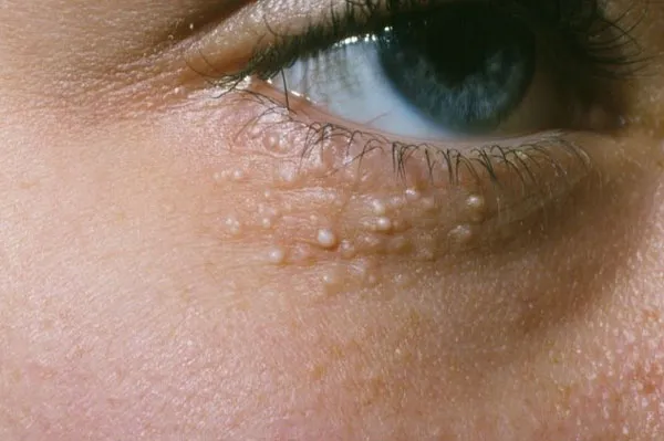 Hướng dẫn 6 cách hỗ trợ làm sạch mụn thịt quanh mắt giúp cải thiện đáng kể điểm tại nhà 2