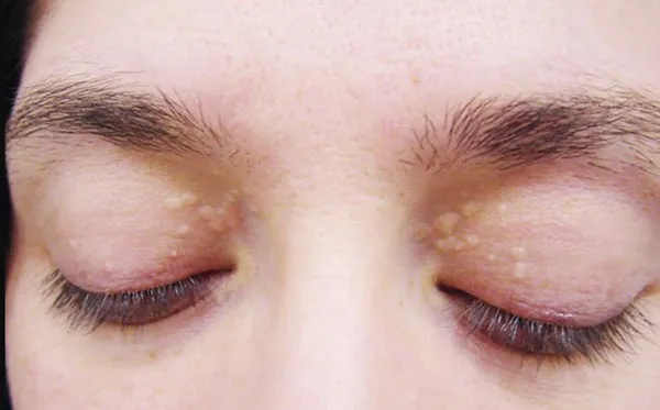 Hướng dẫn 6 cách hỗ trợ làm sạch mụn thịt quanh mắt giúp cải thiện đáng kể điểm tại nhà 4