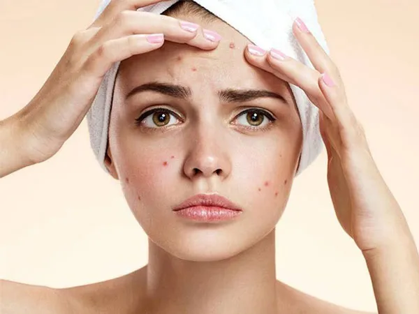 Review chi tiết 10 sản phẩm skincare cho da khô mụn nổi trội định phải biết