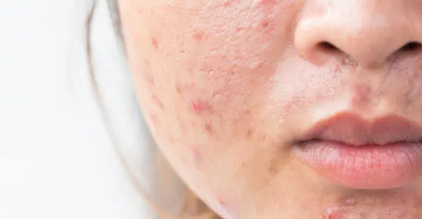 Review chi tiết 10 sản phẩm skincare cho da khô mụn nổi trội định phải biết