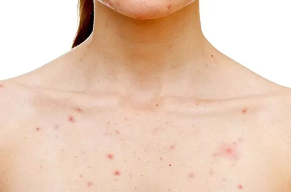 Top 11 sữa tắm trị viêm nang lông hiệu quả hiện nay - 1