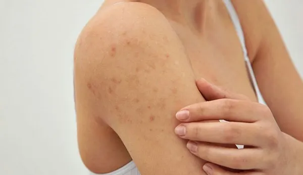 Top 11 sữa tắm trị viêm nang lông hiệu quả hiện nay - 2