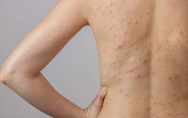 Top 11 sữa tắm trị viêm nang lông hiệu quả hiện nay - 4