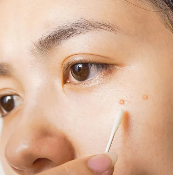 Top 11 kem chấm mụn hiệu quả nhanh được được tin tưởng nhiều 1