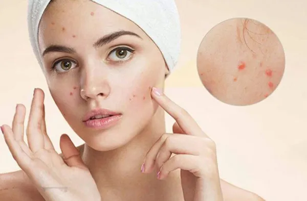 Top 11 kem chấm mụn hiệu quả nhanh được được tin tưởng nhiều 3