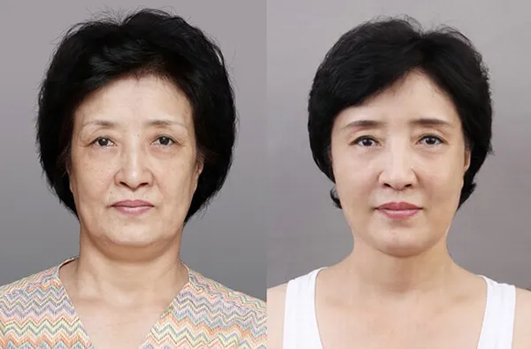 Review 5 máy nâng cơ mặt tại nhà hiệu quả không cần phẫu thuật - 1