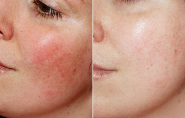 Peel da là gì có tốt không? Chăm sóc da sau peel hiệu quả