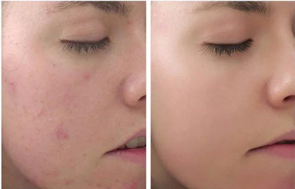 Peel da là gì có tốt không? Chăm sóc da sau peel hiệu quả