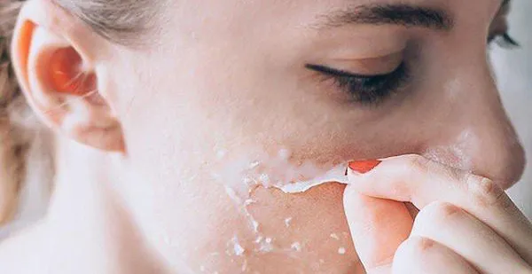 Peel da là gì có tốt không? Chăm sóc da sau peel hiệu quả