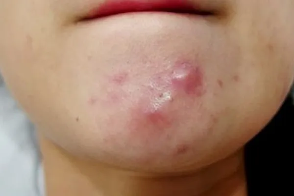 Top 6 cách hỗ trợ cải thiện mụn mọc quanh miệng giúp cải thiện đáng kể điểm nhanh chóng