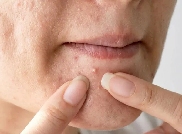 Top 6 cách hỗ trợ cải thiện mụn mọc quanh miệng giúp cải thiện đáng kể điểm nhanh chóng