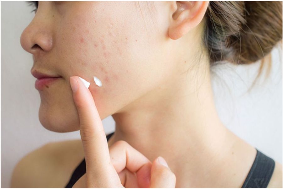 Thâm mụn bao lâu thì hết? Chọn kem trị hết thâm mụn trong 1 tuần